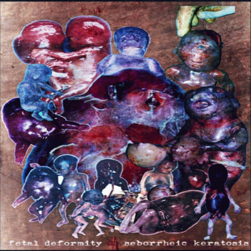 Seborrheic Keratosis : Fetal Deformity - Seborrheic Keratosis